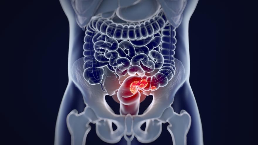Texto Alternativo: Probamos la eficacia del ayuno de corta duración en enfermos de cáncer colorrectal
