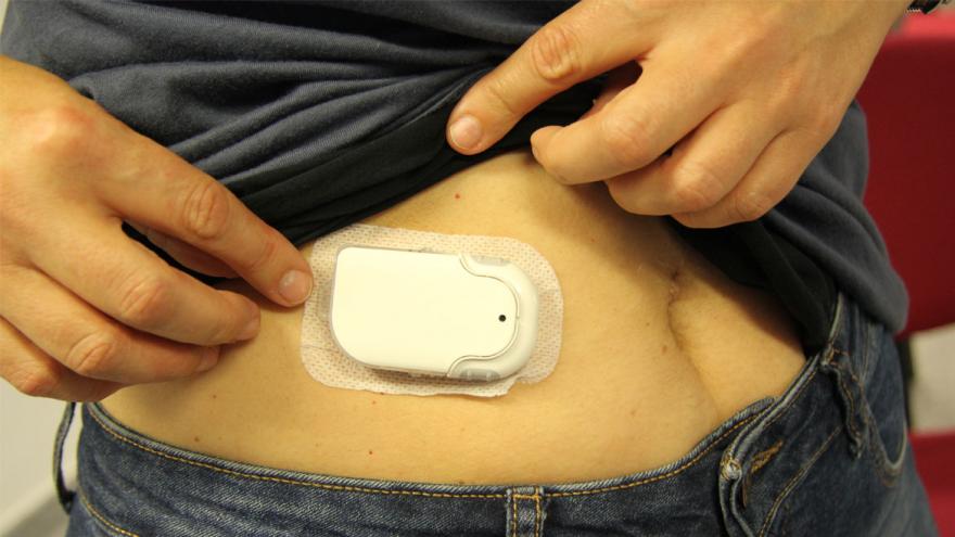 Texto Alternativo: El Hospital Universitario del Sureste comienza la implantación de bombas de insulina