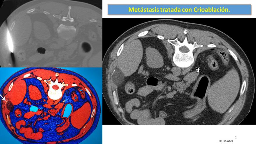 Texto Alternativo: Profesionales del Hospital Fundación Alcorcón publican un estudio sobre las metástasis óseas