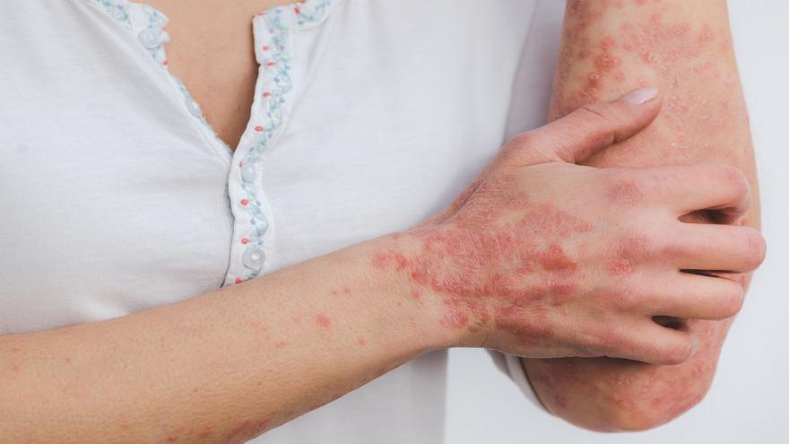 Texto Alternativo: El Hospital del Sureste incorpora la experiencia del paciente en Dermatología