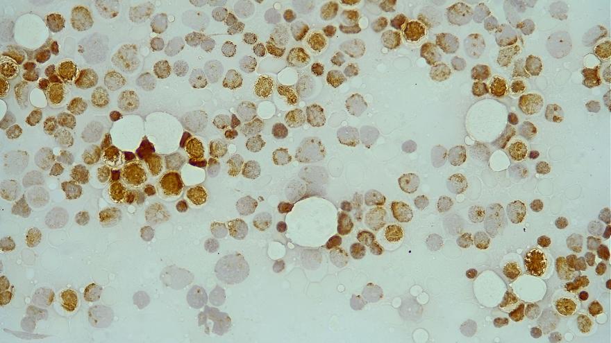 Texto Alternativo: Las alteraciones de unas proteínas detectarían casos de leucemia mieloide aguda que no responden a la terapia estándar