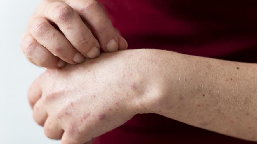 Texto Alternativo: El Servicio de Dermatología del Hospital público Universitario de La Princesa organiza una sesión internacional sobre Inmunodermatología