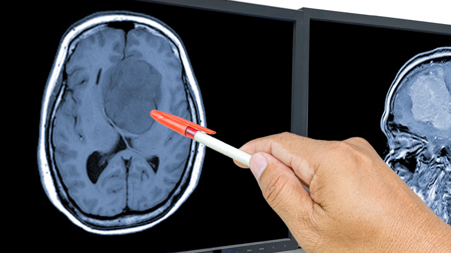 Texto Alternativo: El Hospital público 12 de Octubre, primer centro español en un ensayo internacional sobre la eficacia de un fármaco en glioblastoma